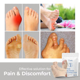 Hallux Valgus Teen Corrector | Orthopedische Bunion Spalk | Zachte Gel | 1 Paar