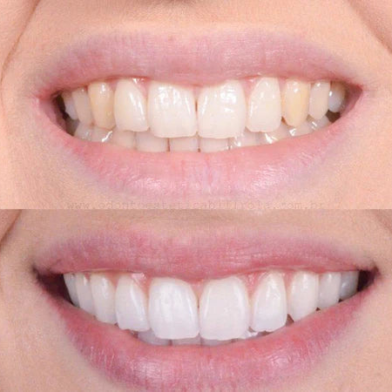 SmilePure™ Voor Stralend Witte Tanden en Gezond Tandvlees