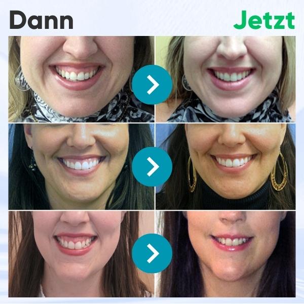 Smile™ | tandvleestherapie gel