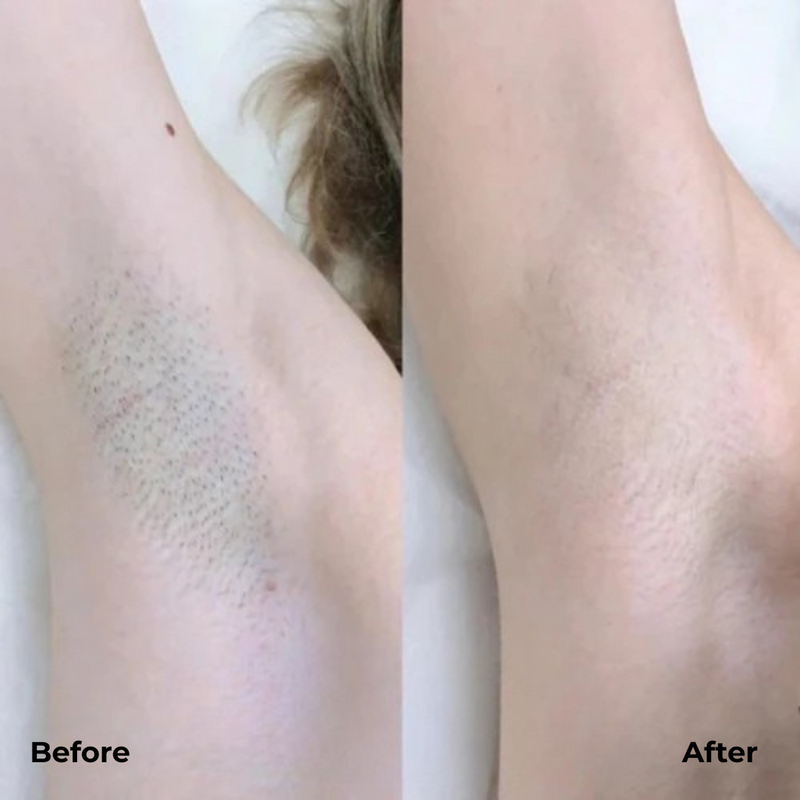 GlansTrim | Elektrische Precisietrimmer | Zachte & Pijnloze Ontharing voor Gezicht en Lichaam