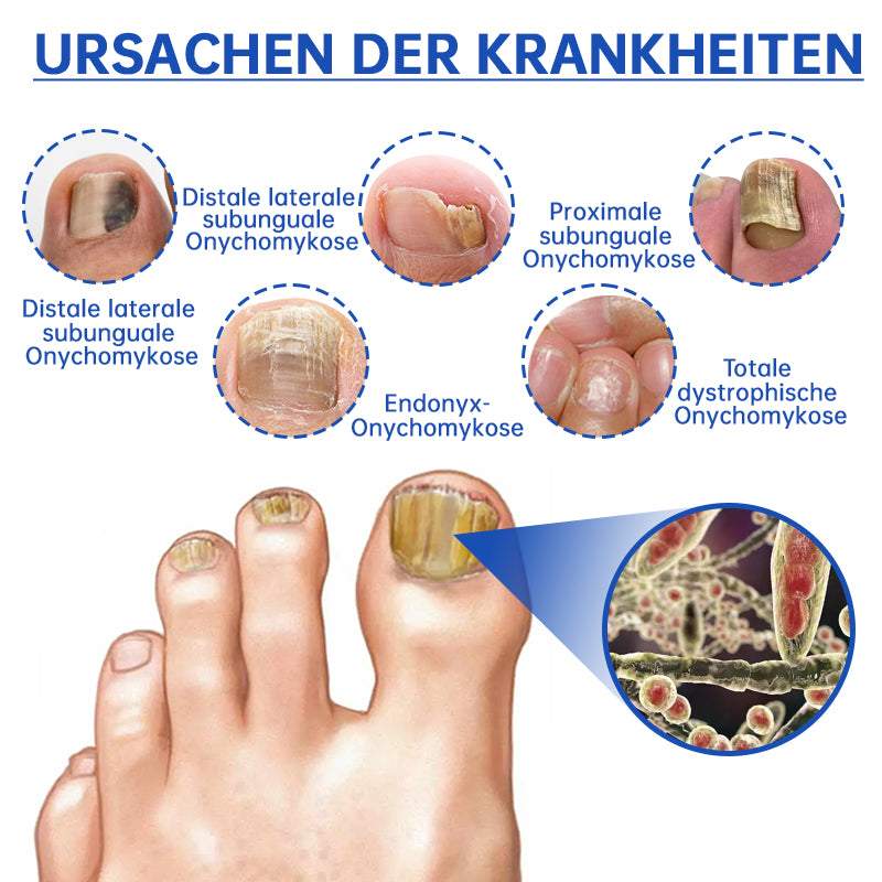 SchimmelVrij™ Vernieuw de nagelgezondheid in slechts enkele weken