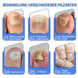 SchimmelVrij™ Vernieuw de nagelgezondheid in slechts enkele weken