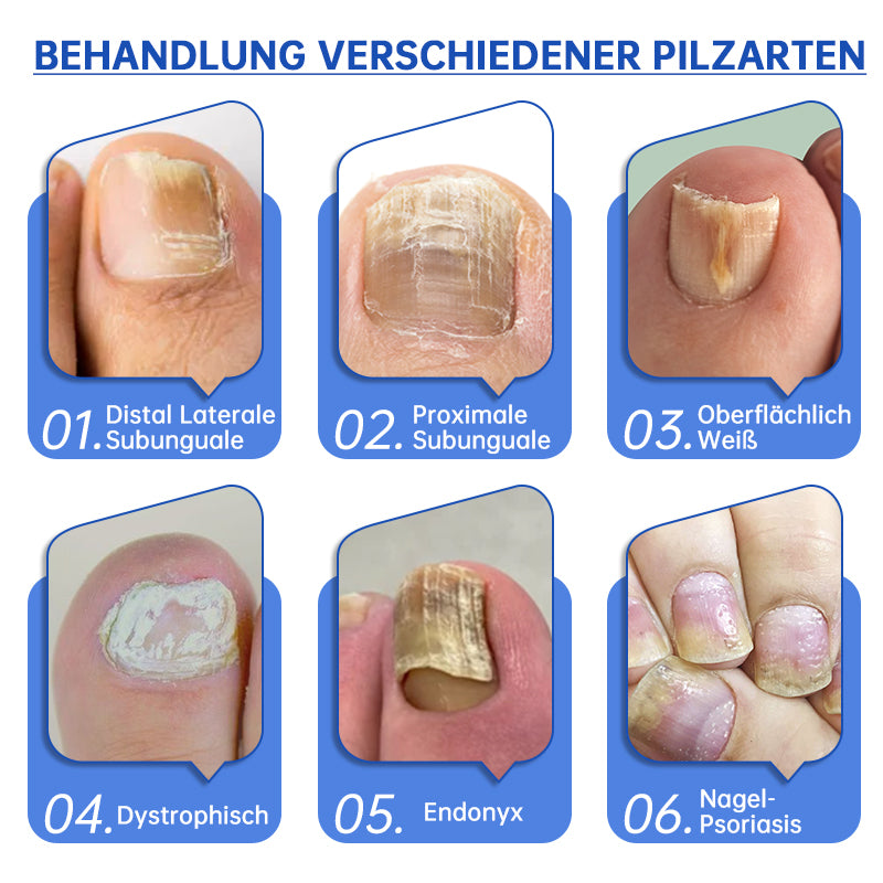 SchimmelVrij™ Vernieuw de nagelgezondheid in slechts enkele weken