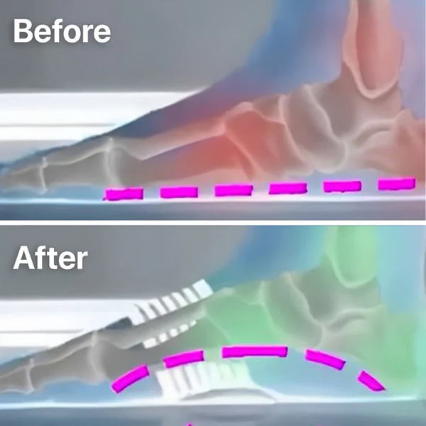 1+1 Gratis | ArchBewaker™ Orthopedische Voetboogondersteuning