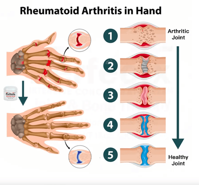 FlexiCrème™ Gewrichts- en bottherapiecrème