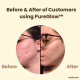 1+1 Gratis | Gezichtsmasker | Zwarte Thee & Ginseng | Tegen Acne, Rimpels & Huidoneffenheden
