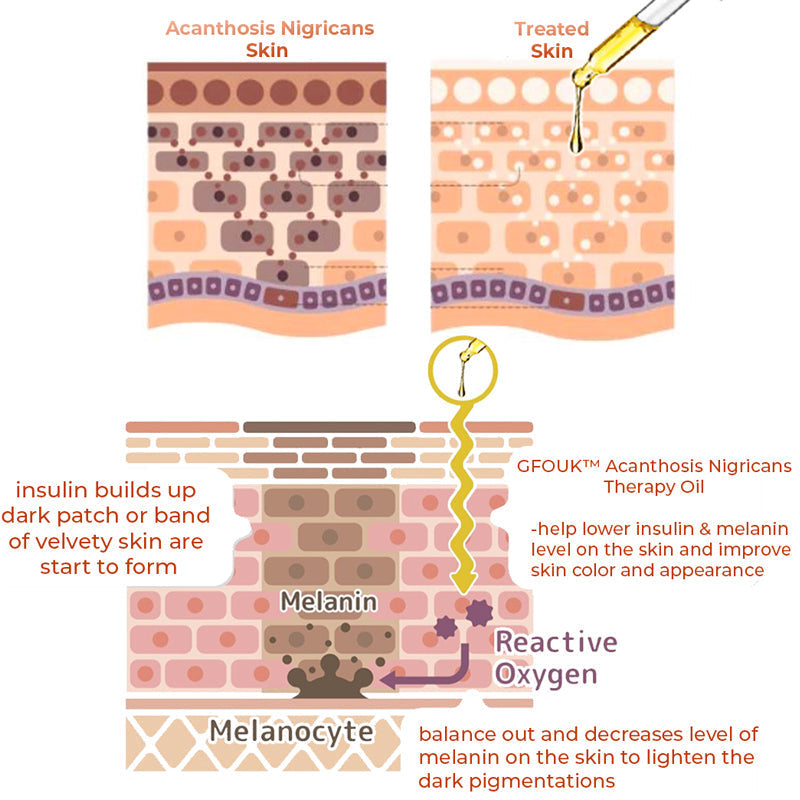 GladdeHuid™ Acanthosis Nigricans Therapieolie